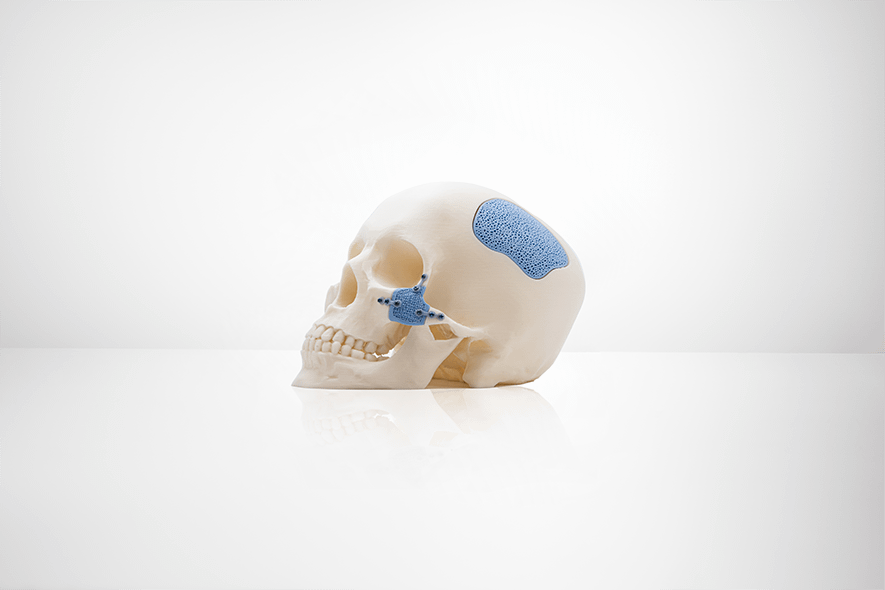 Commercial Applications for Ceramic 3D Printing3DPrint.com | Additive Manufacturing Business 2 LITHOZ LithaBone Cranial and Zygomatic Implant 3bJdjL