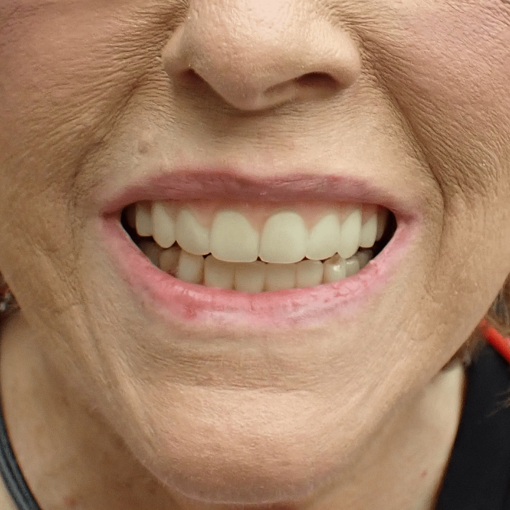 Something to Smile About: 3D Systems Announces Commercial Release of 3D Printed Denture Solution3DPrint.com | Additive Manufacturing Business 2 3d systems jetted dentures patient 6suFAW