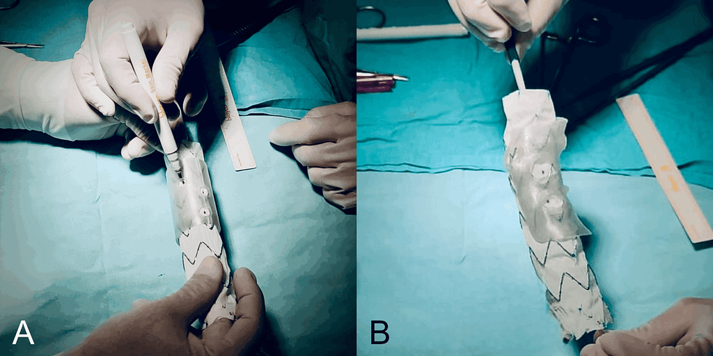 Surgeons Test Fast, Low-Cost 3D Printed Template to Improve Custom Stent-Grafts3DPrint.com | Additive Manufacturing Business 2 lightbo f34bdc70b07611f094989395c94cc3a4 Figure 4 scaled tDmXmH