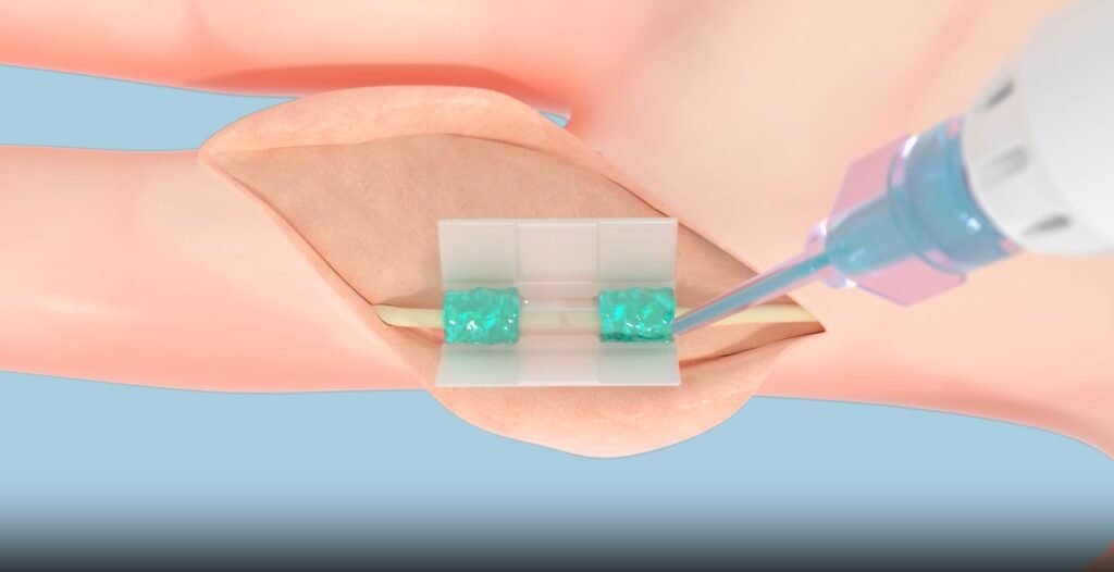 3D Printing News Briefs, July 12, 2025: Nerve Repair, Glass Nanostructures, adidas, & More3DPrint.com | The Voice of 3D Printing / Additive Manufacturing 10 COAPTIUM picture 3 1024x526 H9MhzE