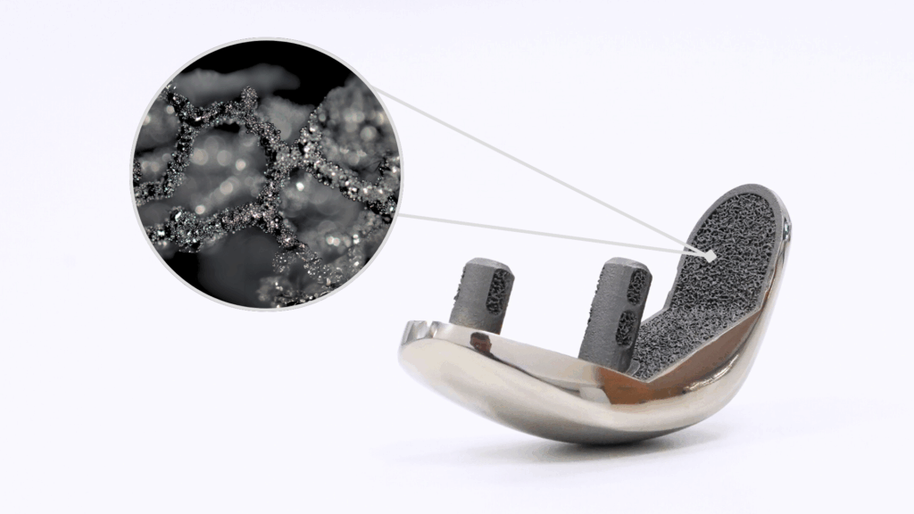 Croom Medical Releases Porous Biofuse Geometry for 3D Printed Lattices3DPrint.com | Additive Manufacturing Business 11 Partial Knee Implant with BiofuseE284A2 3D Printed Lattice Structure manufactured using Laser Powder Bed Fusion technology in Ti64 Grade 23 1024x576 RSGHny
