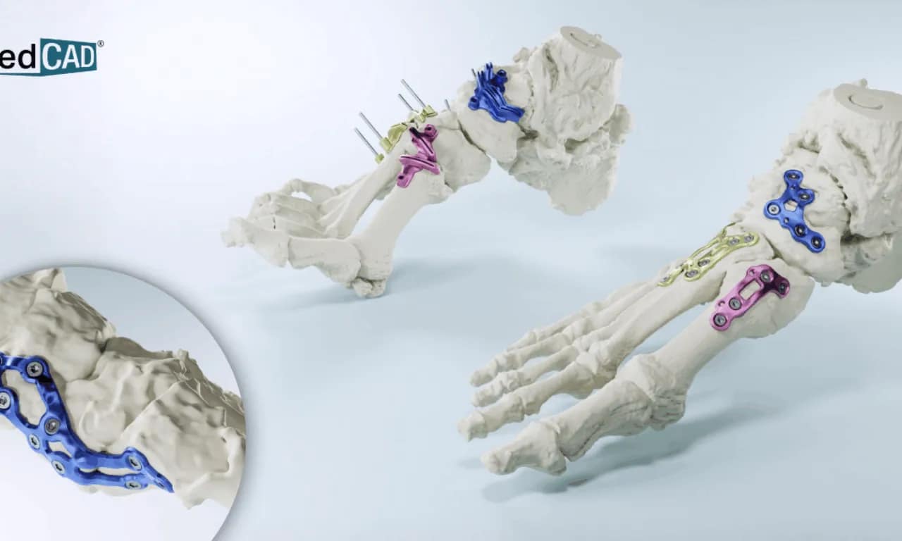 FDA Clears MedCAD’s 3D Printed Guides That Could Cut Surgery Time3DPrint.com | Additive Manufacturing Business 1 AccuStride Launch Graphic 1280768 c 1 jHHh5S