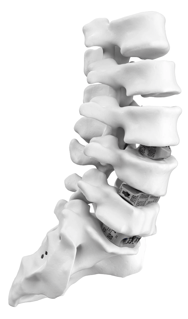 Carlsmed to Go Public in $101 Million Bid to Scale 3D Printed Spine Implants3DPrint.com | The Voice of 3D Printing / Additive Manufacturing 2 Multilevel SPINE NEW LLIF and OLIF posistion scaled 1 DgaUYQ