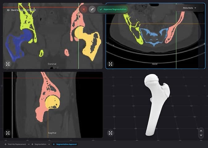 CustoMED Gets $6 Million for AI 3D Printed Orthopedics — But Can It Deliver on Such a Big Vision?3DPrint.com | Additive Manufacturing Business 2 CustoMED Jig Editor Edit Prostheses v1 viJJKT
